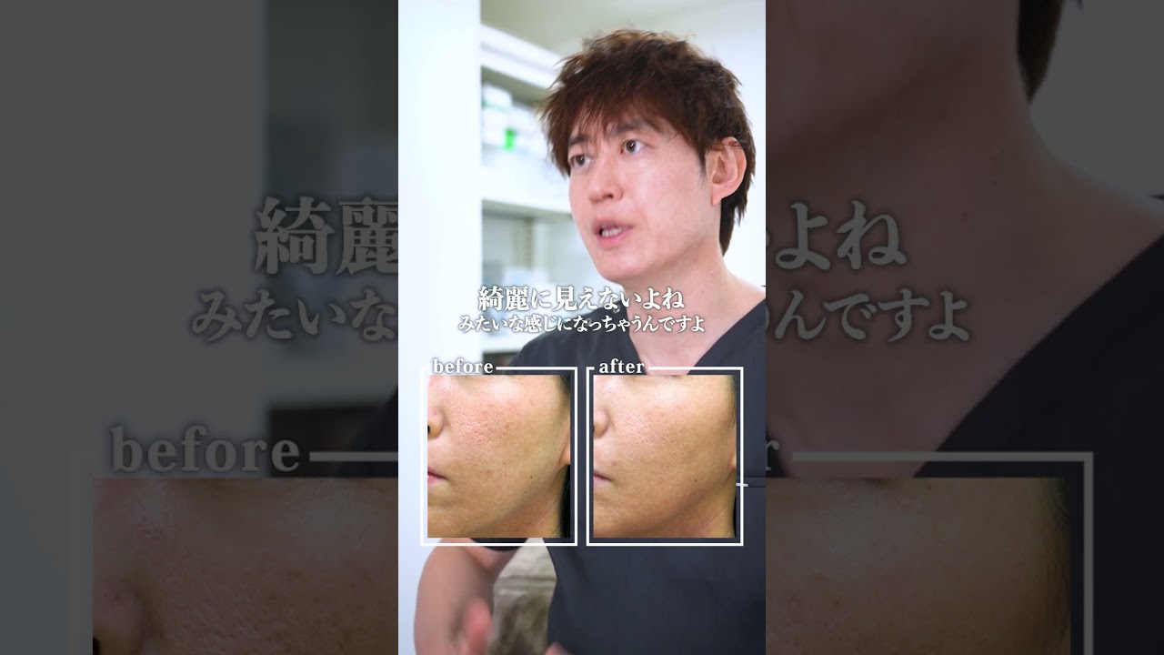 1度の治療で変化はどれくらい?┃ニキビ跡治療
