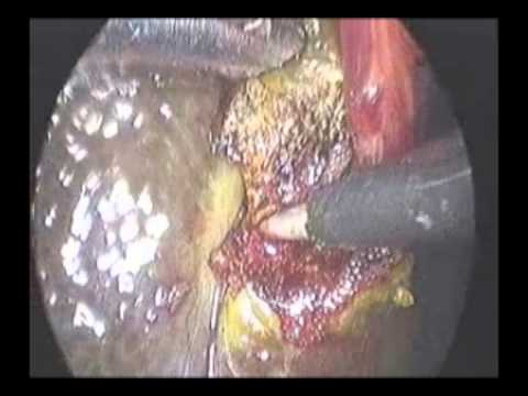 Laparoscopic Liver biopsy