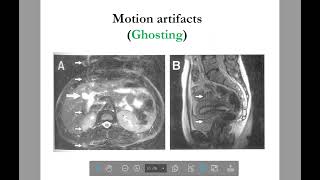 MRI physics of common MRI Artifacts