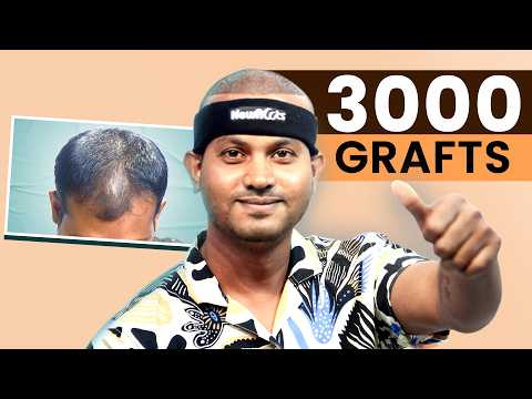 Smooth & Comfortable Hair Transplant Surgery 😱 | Hair Transplant in Kolkata | New Roots