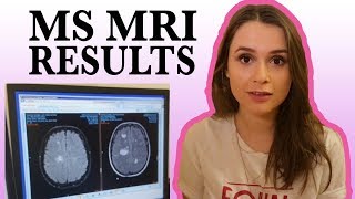 1 Year With Aggressive Multiple Sclerosis: MRI Results