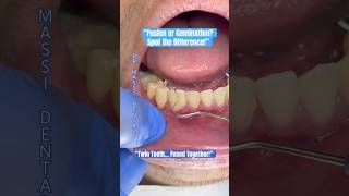“Twin Teeth… Fused Together!”“Fusion or Gemination Spot the Difference!”