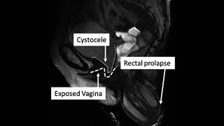 Podcast 792: Rectal Prolapse