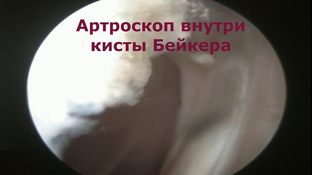 Киста Бейкера. Артроскопия коленного сустава, санация подколенной кисты.