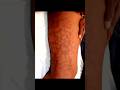 Xesteliklerin differensial diaqnostikasi livedo reticularis fleboloq damar cerrahi ismayil esgerov