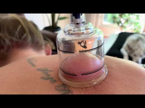 Cupping Therapy Tutorial