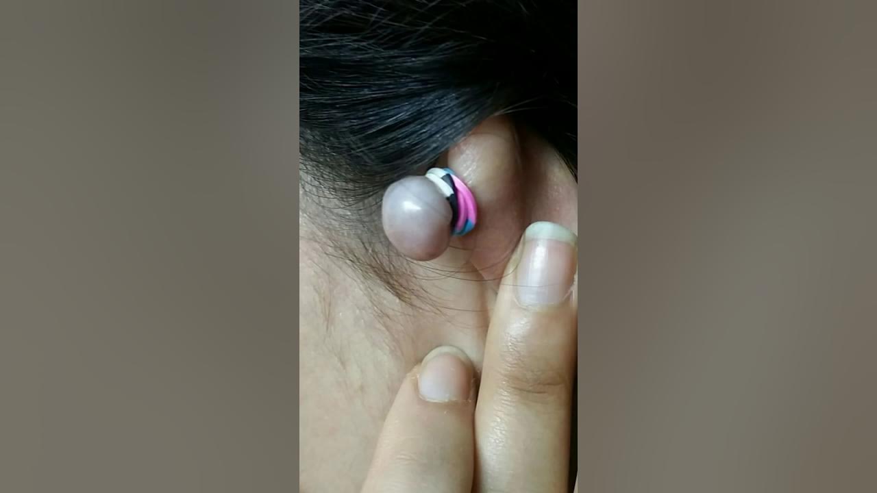 How to remove a keloid (with rubber band) YouTube