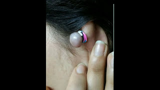 How to remove a keloid (with rubber band) Resimi