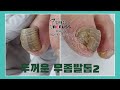 “아파서 못걷겠어요” 무좀발톱 통증 없이 관리 part 2! Getting rid of thick black fungal toenails part 2!