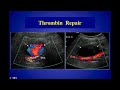 Pseudoaneurysms  Diagnosis and Treatment Ultrasound Video Lecture