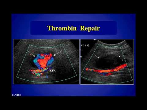 Video: Pseudoaneurysm: Symptomer, årsaker, Diagnose, Behandling