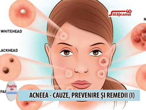 Video: Acneea - Cauze, Simptome, Metode De Prevenire, Tratament, Remedii Populare
