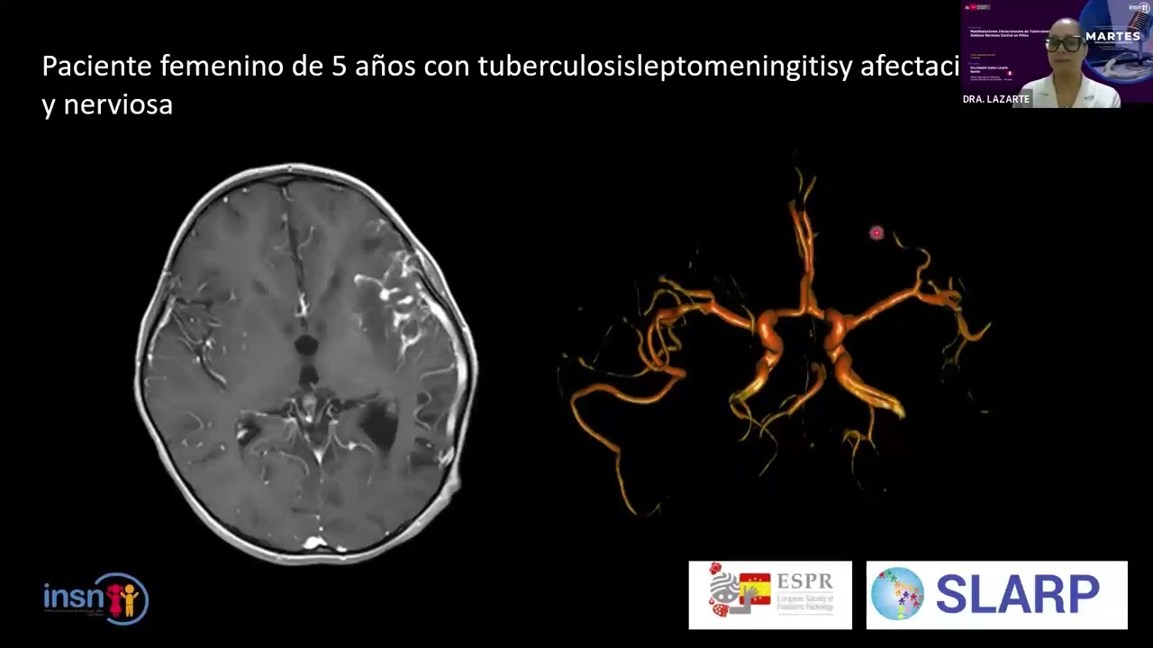 Martes de Divulgación Científica - 16 de diciembre 2025 - Tuberculosis cerebral