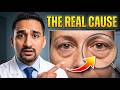 आंखों के नीचे सूजन (Eye Bags) का पक्का इलाज: Home Remedies vs Surgery? Eye Doctor Explains