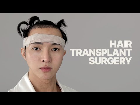 This is my Hair Transplant Journey thumbnail