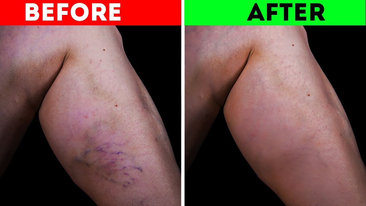 get rid of varicose veins with exercise Natural Home Treatment For Varicose Veins In Pregnancy!