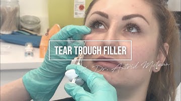 Tear Trough Filler - Treat Dark Circles with Dermal Fillers