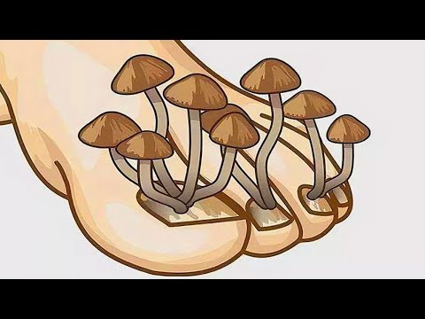 Dein Fußpilz verschwindet