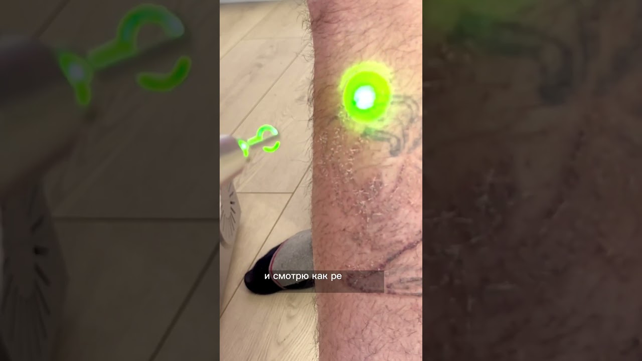 Удаление татуировки лазером. Москва.