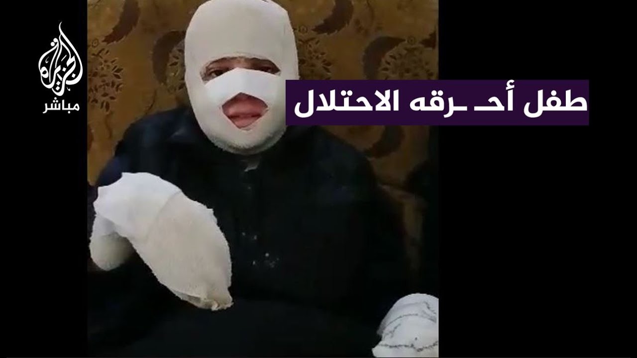 "تشوهــ ــات بالوجه واليدين".. طفل أصيب بحـ ــــروق بالغة جراء قصــف الاحتلال