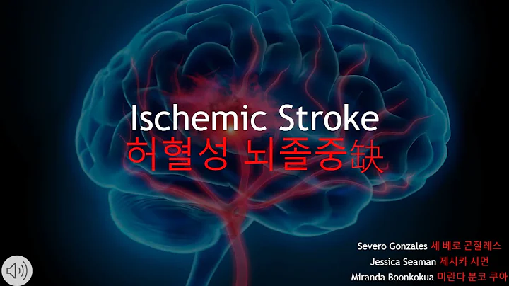 Ischemic Stroke Presentation