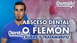 Cómo curar un FLEMÓN  Causas, tratamiento y remedios caseros del ABSCESO dental | Dentalk! ©