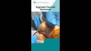 Ingrown Toenail Removal