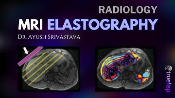 MRI Elastography of the Liver| Dr. Ayush Srivastava | Radiology