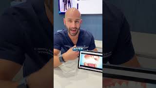 How Invisalign Works, in 25 Seconds.