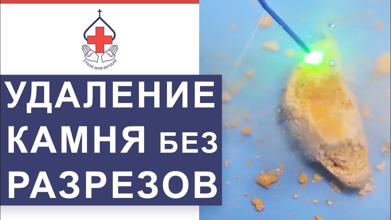 💎 Как лечить мочекаменную болезнь. Лечение мочекаменной болезни. 12+