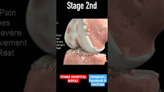 Osteoarthritis 3D Animation