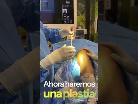 Extraccion Postero-Medial del Semitendinoso LCA Dr Pedro Bernaldez SportMe Medical Center (Sevilla)