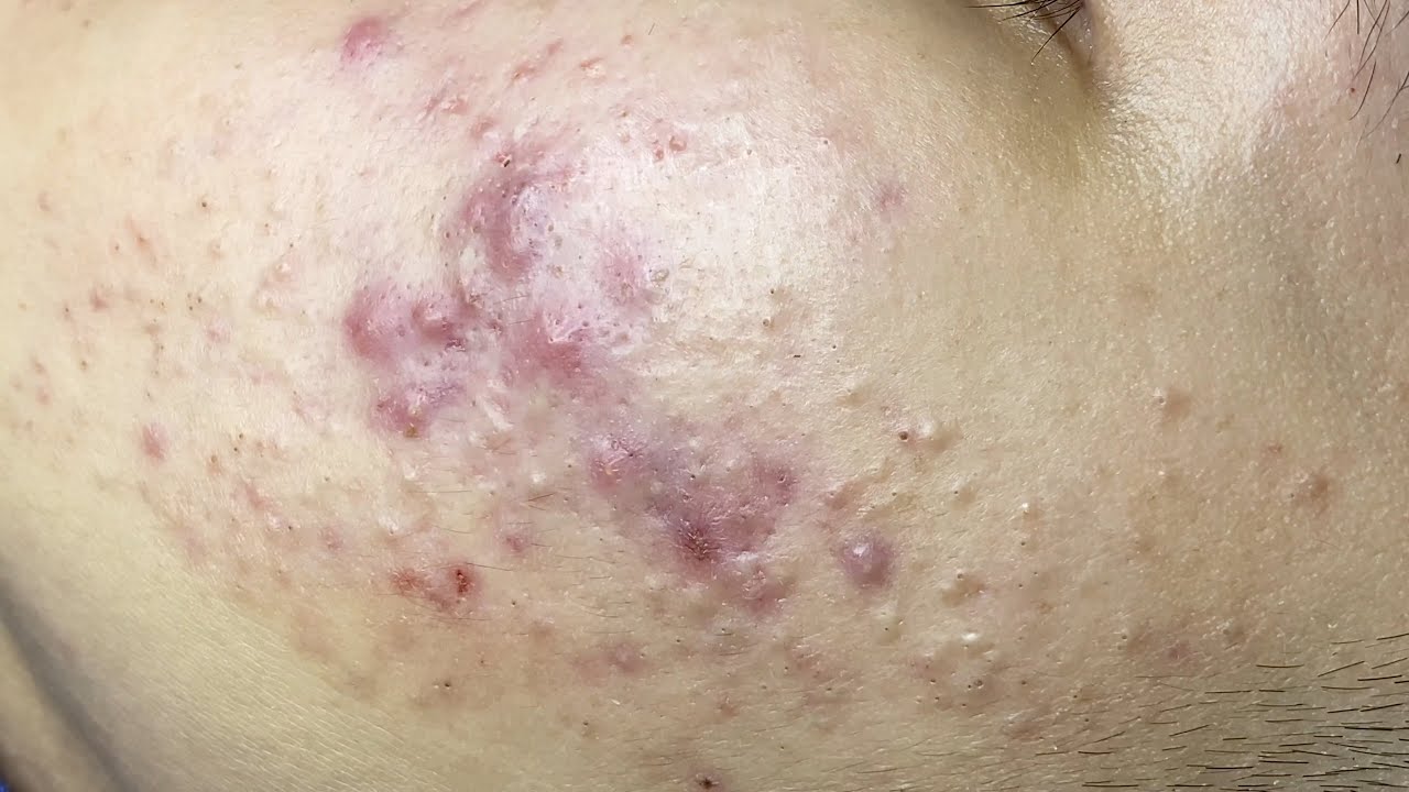 Puberty Acne | Mụn Trứng Cá, Mụn Viêm - SacDepSpa#321