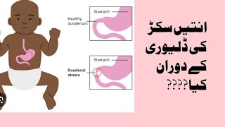 fetal duodenal atresia shown by ultrasound/double bubble sign/fetal anamoly /polyhydramnions