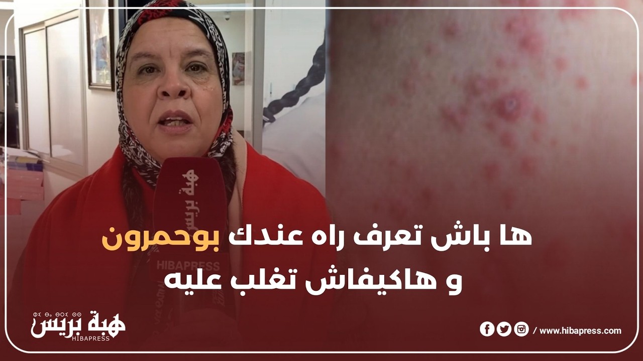أعراض و طرق الوقاية من داء الحصبة بوحمرون مع مسؤولة التواصل بالمديرية الجهوية للصحة فاس