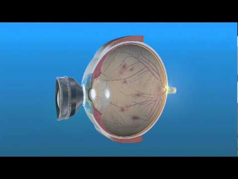 Video: Puas panretinal photocoagulation kho mob ntshav qab zib retinopathy?