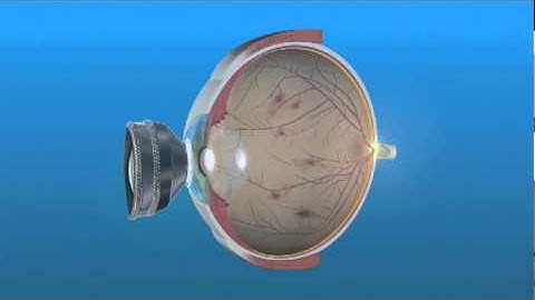 Panretinal Photocoagulation PRP