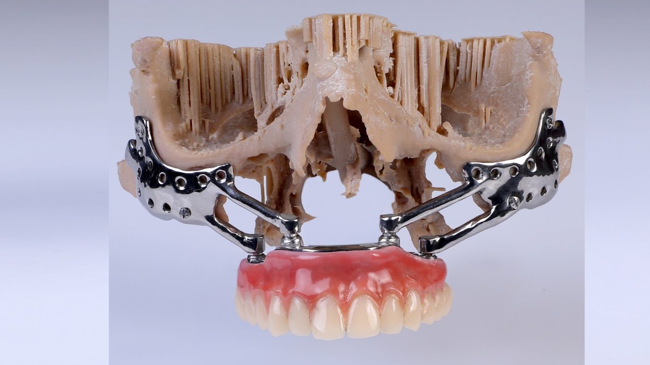 PATIENT SPECIFIC ZYGOMA IMPLANT FOR POST MUCORMYCOSIS MAXILLECTOMY