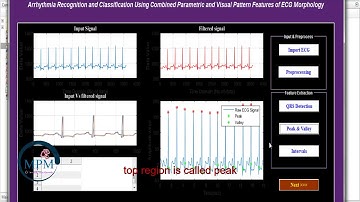 Arrhythmia Recognition and Classification Using Combined Parametric & Pattern Features | EEG MATLAB