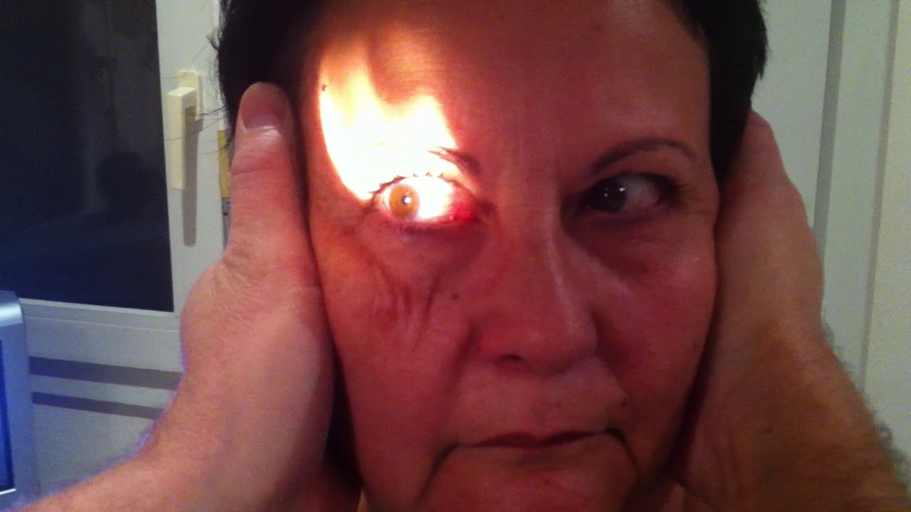 Signe d'halmagyi gauche vitesse réelle-Dr Philippe Lorin-Le Mans