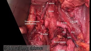 rectosigmoid ráksugárzás