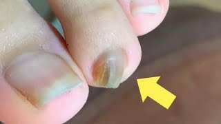 爪切りでは切れない程に厚みのある足の爪を手入れする Pedicure Vol.19