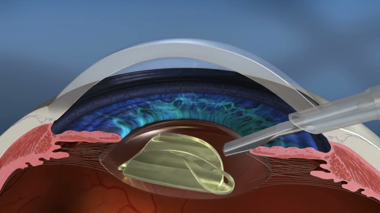 LenSx LASER Assisted Cataract vs Standard Manual Phaco Cataract Animation