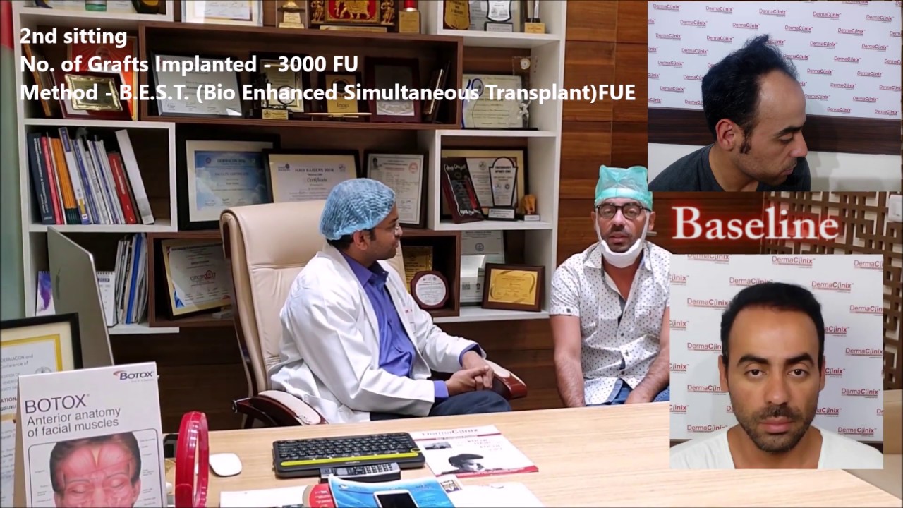 Hair Transplant Testimonial Brazilian Patient - DermaClinix India | Dr Kavish Chouhan, MD (AIIMS)