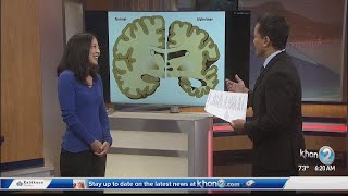 Ask a Specialist: Dementia