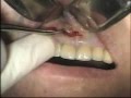 Apicoectomy And Retrofil