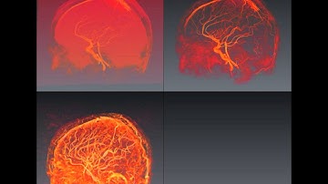Comparaison of RORPO against Frangi