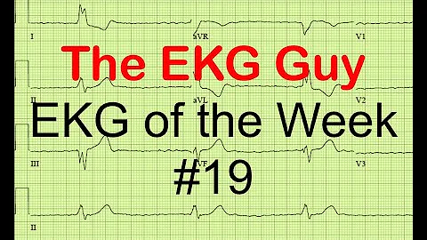 EKG/ECG of the Week #19 | The EKG Guy - www.ekg.md
