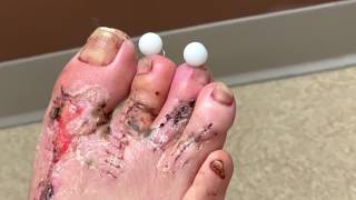 Removing pins from foot | Dr. Nicholas Campitelli