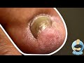 THE DOUBLE WHAMMY INGROWN **AND** TOTAL TOENAIL REMOVAL